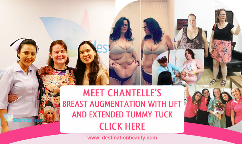 Chantelle's massive surgery - tummy tuck and breast lift in Bangkok after losing 100 kgs!