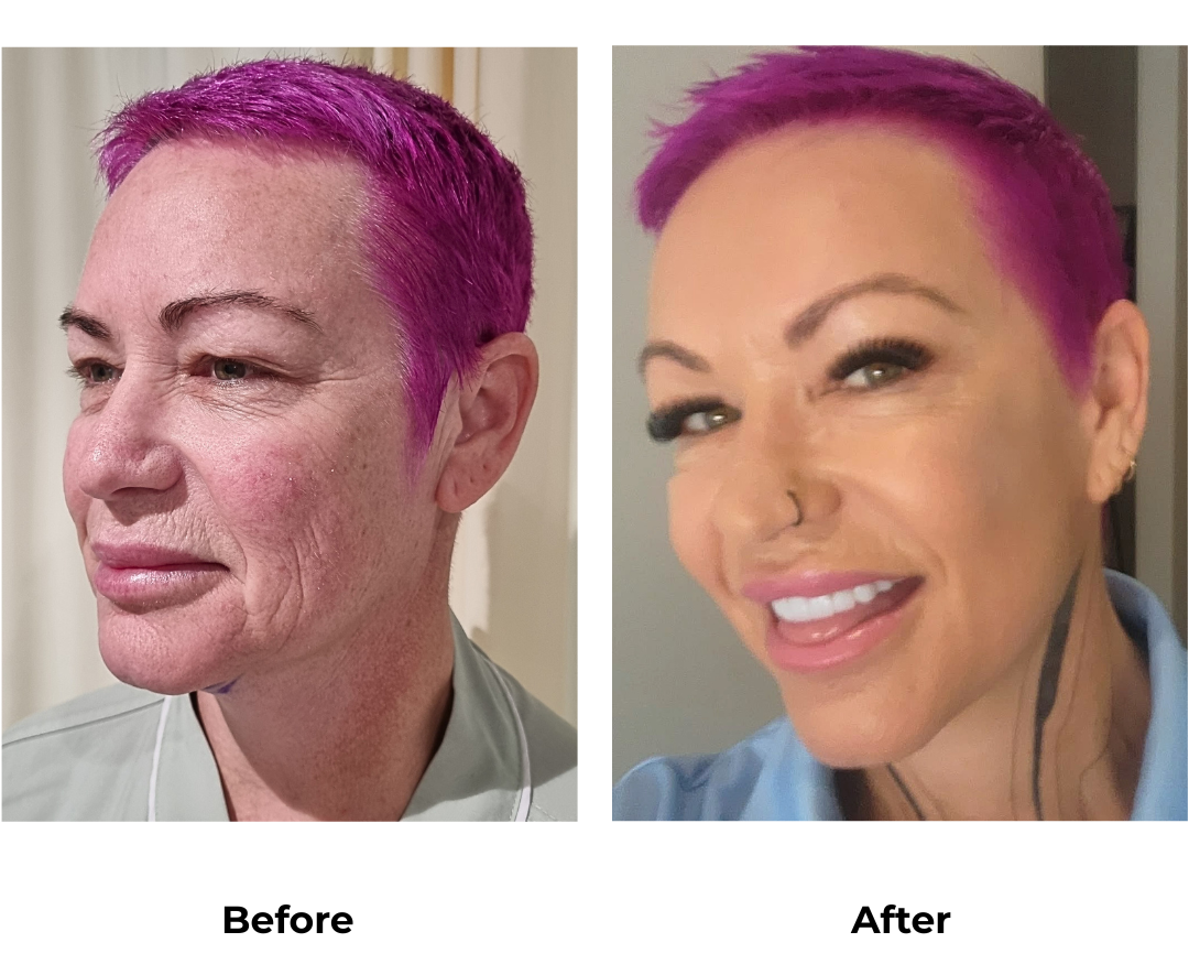 Chastity had FFNL + Direct Brow Lift with Dr. NJ (1)