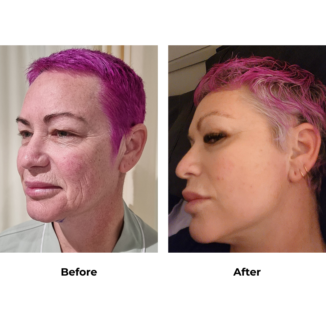 Chastity had FFNL + Direct Brow Lift with Dr. NJ (3)