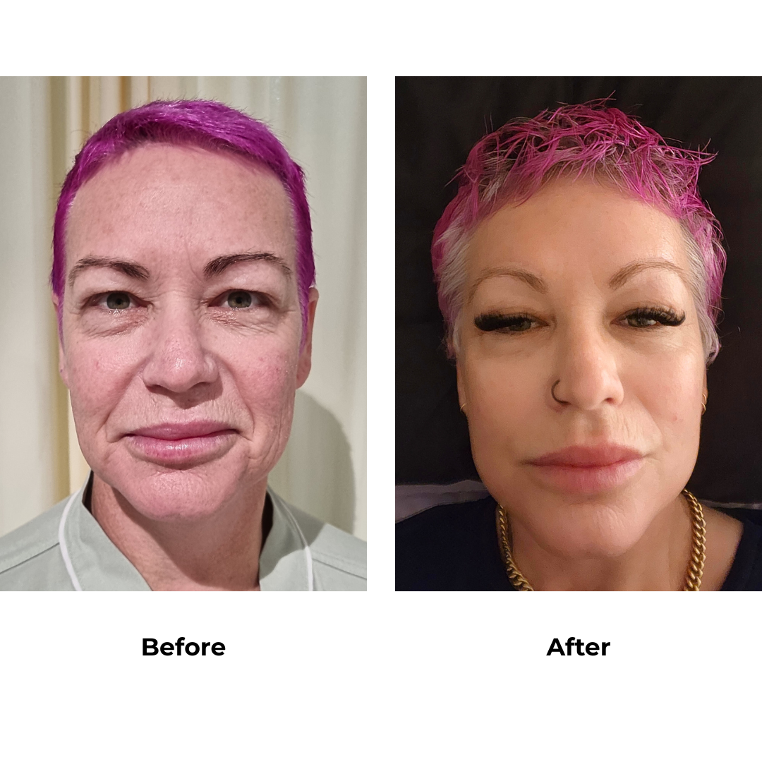 Chastity had FFNL + Direct Brow Lift with Dr. NJ