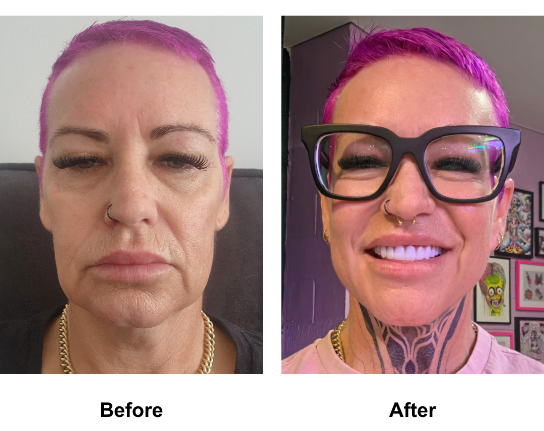 Chastitys 1 year post-facelift with Dr. NJ (1)