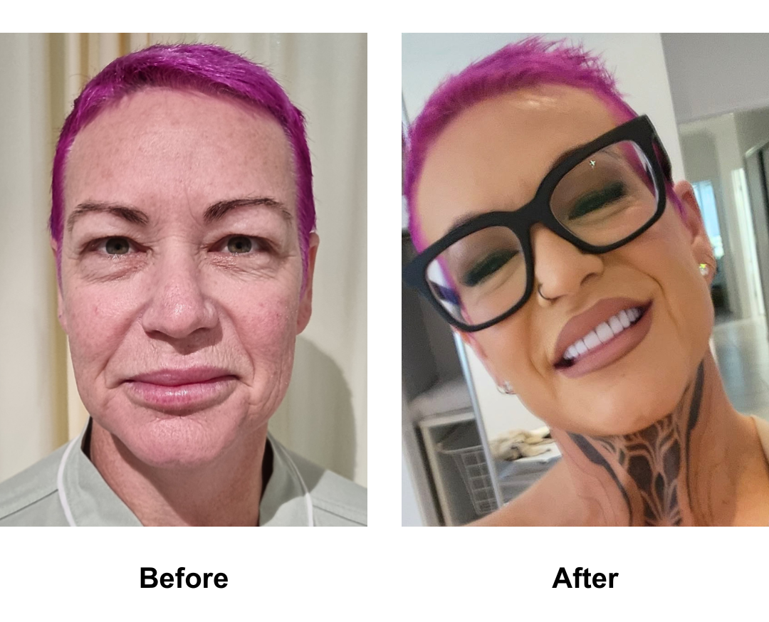 Chastitys 1 year post-facelift with Dr. NJ (2)