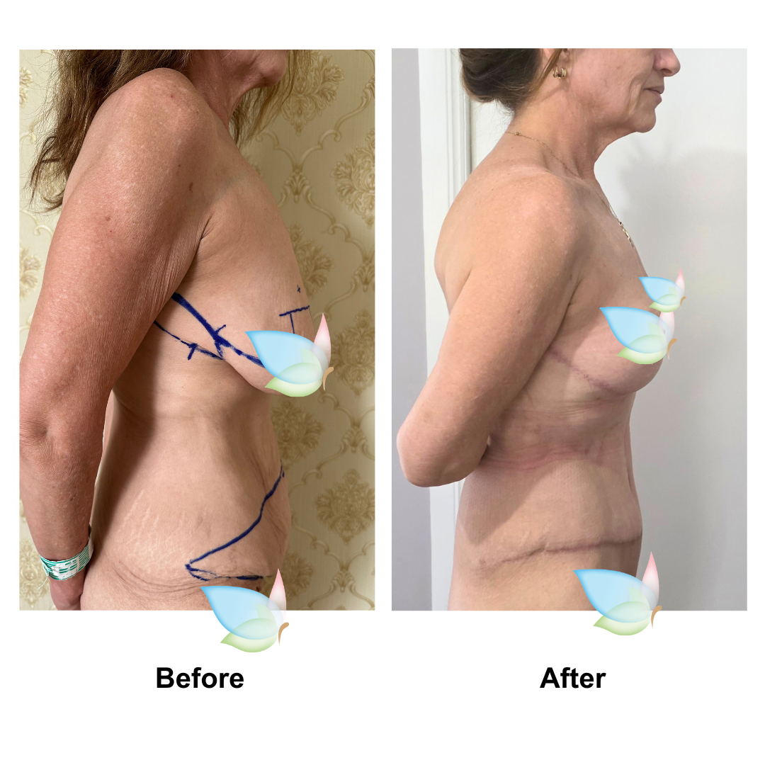 Cherie had BL + SL + ExTT + ML with Dr. Weerachai - 2 months (2)