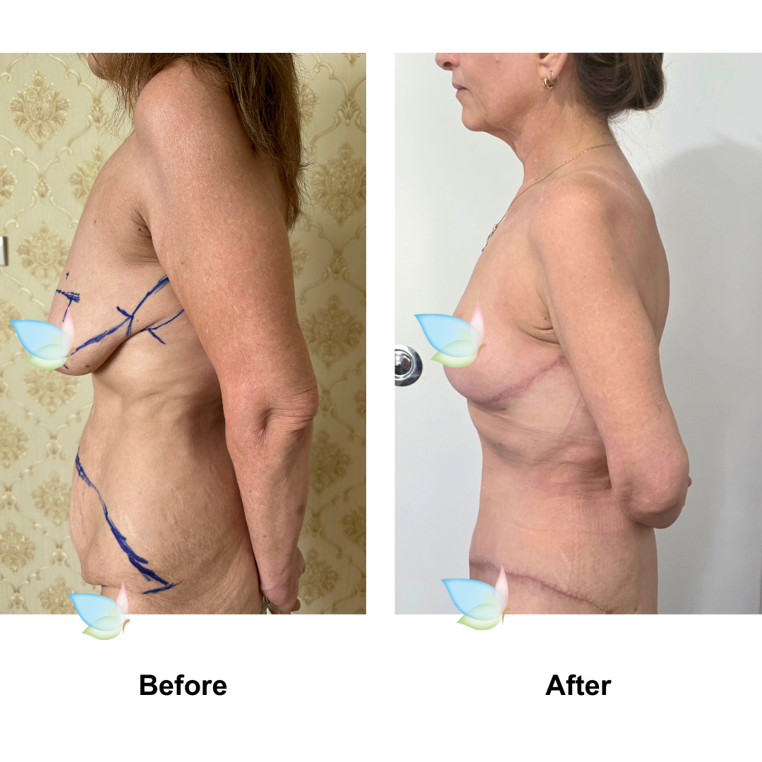 Cherie had BL + SL + ExTT + ML with Dr. Weerachai - 2 months (3)