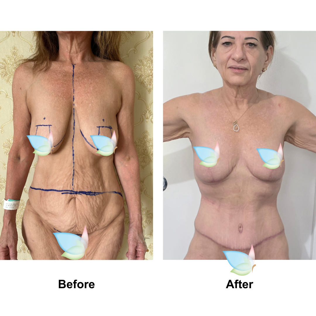 Cherie had BL + SL + ExTT + ML with Dr. Weerachai - 2 months