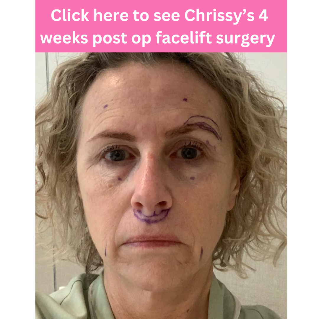 Chrissy facelift