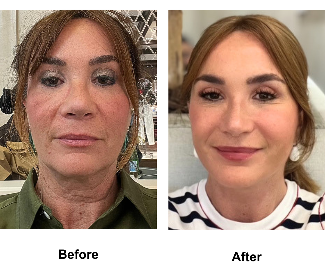 Christele had FFNL + Lipo Chin with Dr. Ring and Rhinoplasty Revision (Rib cartilage + alarplasty) with Dr. Weerakarn