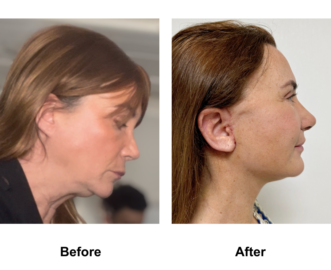 Christele had MFNL + Chin Lift + Fat transfer to Face FFNL + Lipo Chin with Dr. Ring and Rhinoplasty Revision (Rib cartilage + alarplasty) with Dr. Weerakarn (1)-1
