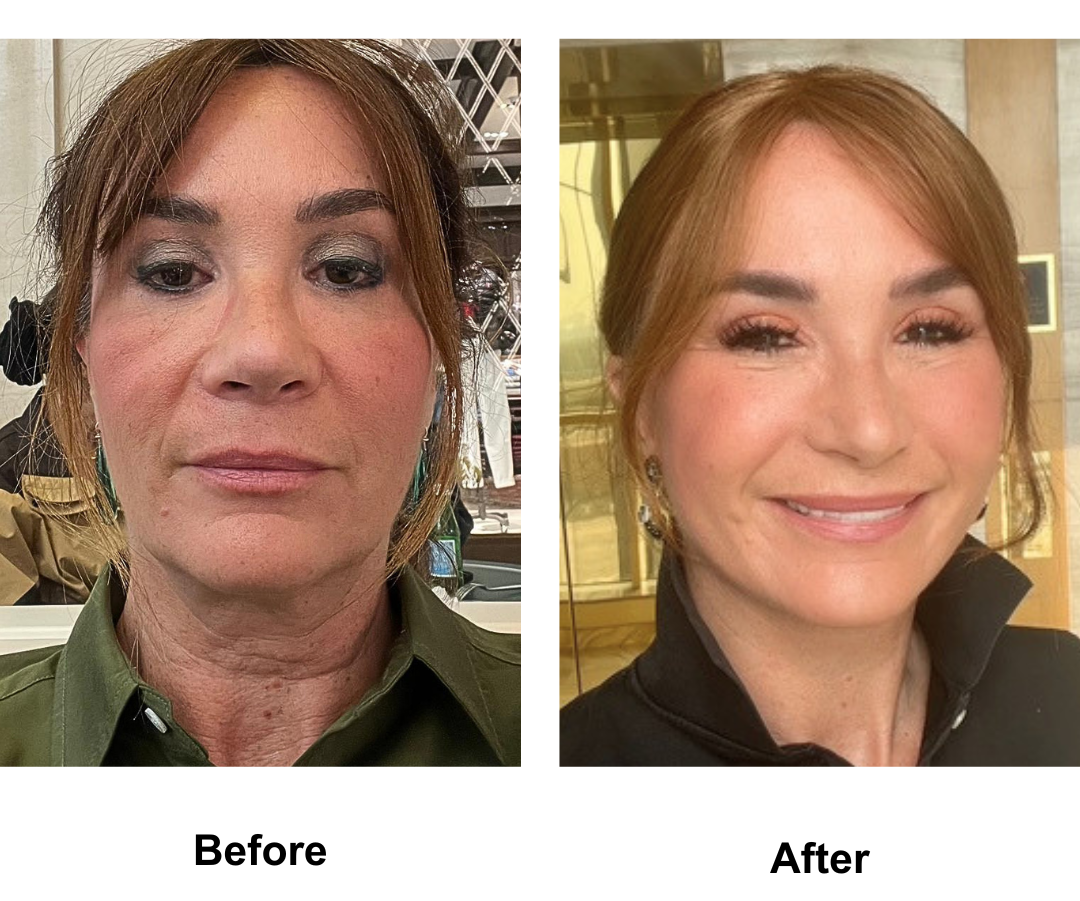 Christele had MFNL + Chin Lift + Fat transfer to Face FFNL + Lipo Chin with Dr. Ring and Rhinoplasty Revision (Rib cartilage + alarplasty) with Dr. Weerakarn (1)