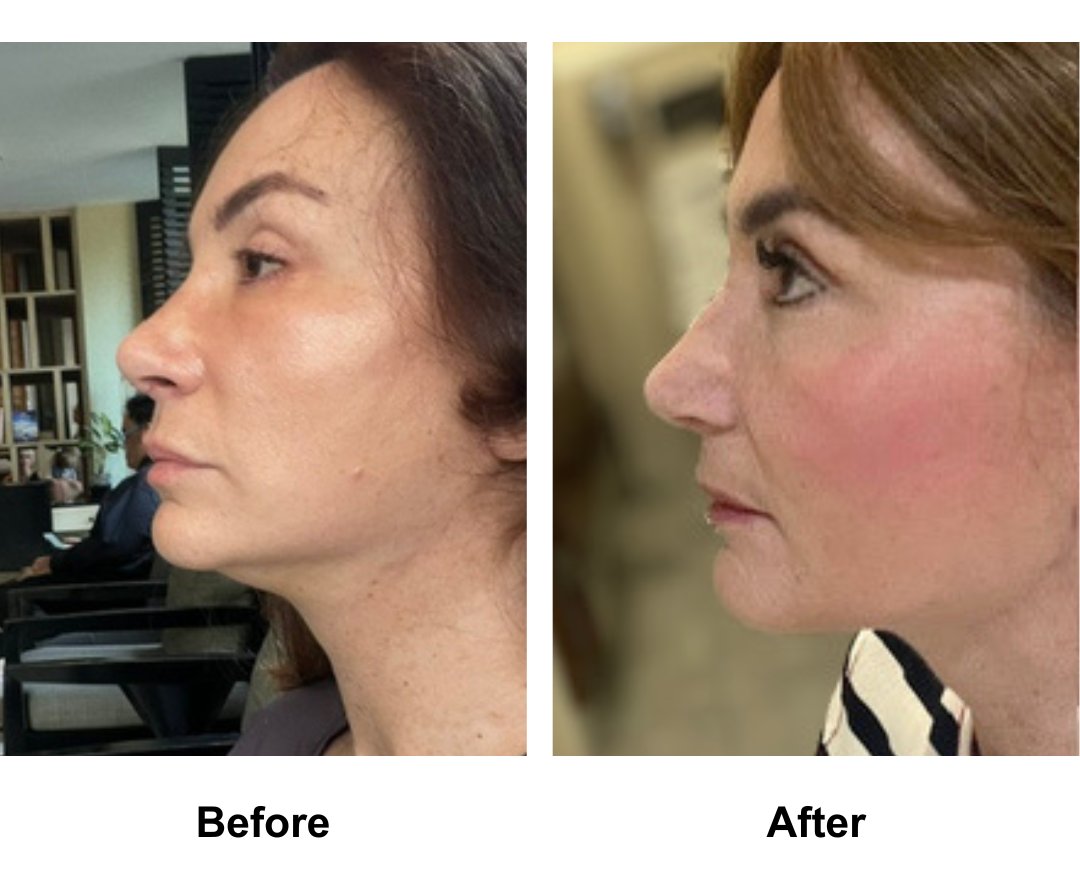 Christele had MFNL + Chin Lift + Fat transfer to Face FFNL + Lipo Chin with Dr. Ring and Rhinoplasty Revision (Rib cartilage + alarplasty) with Dr. Weerakarn (2)