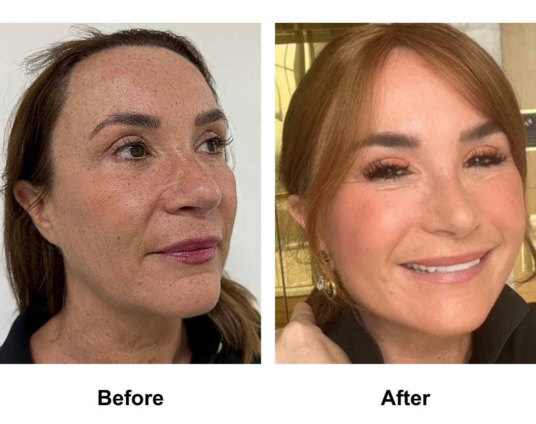 Christele had MFNL + Chin Lift + Fat transfer to Face FFNL + Lipo Chin with Dr. Ring and Rhinoplasty Revision (Rib cartilage + alarplasty) with Dr. Weerakarn