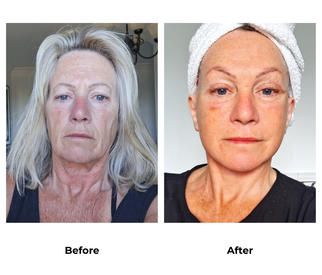 Christine had MFNL, Endo Eyebrow, Platysmaplasty with Dr. NJ