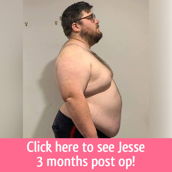  Jesse gastric sleeve