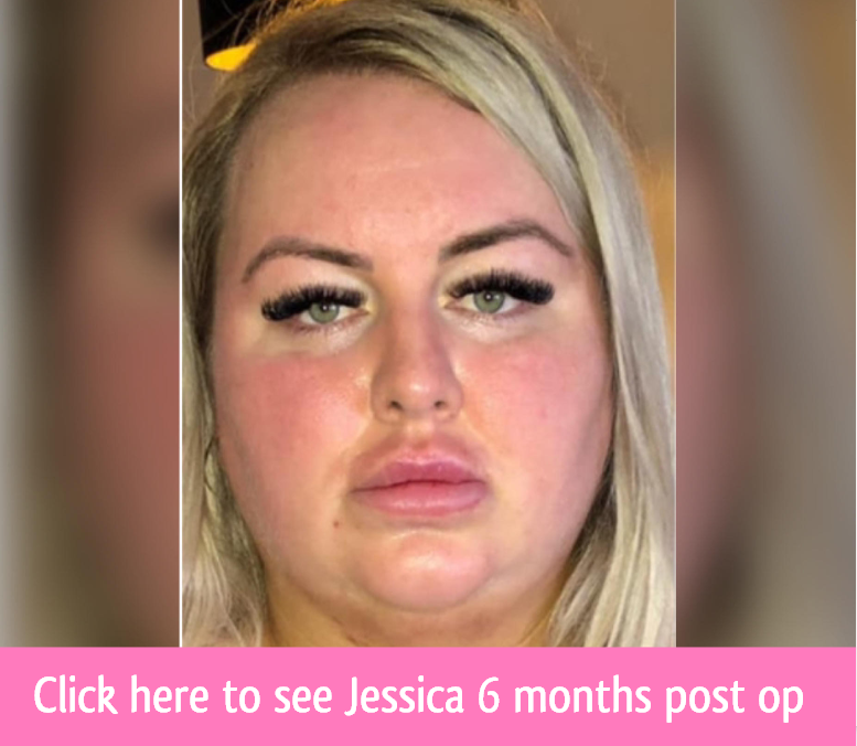 jessica weight loss surgery