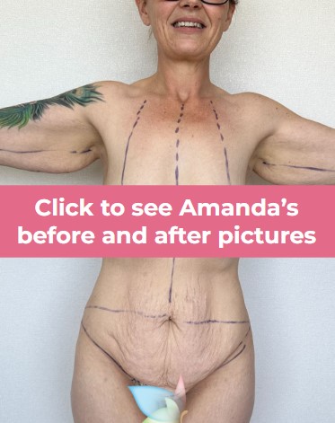 Click to see Amanda B skin removal surgery-1