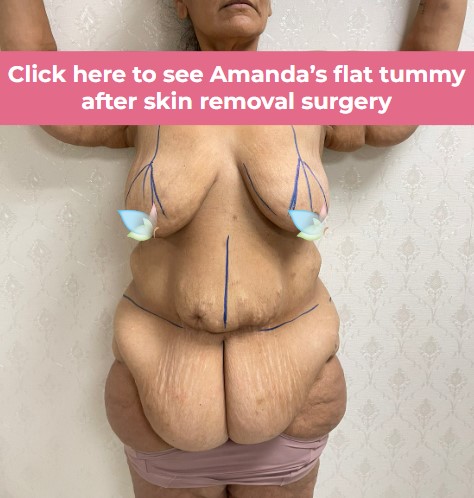 Click to see Amanda skin removal