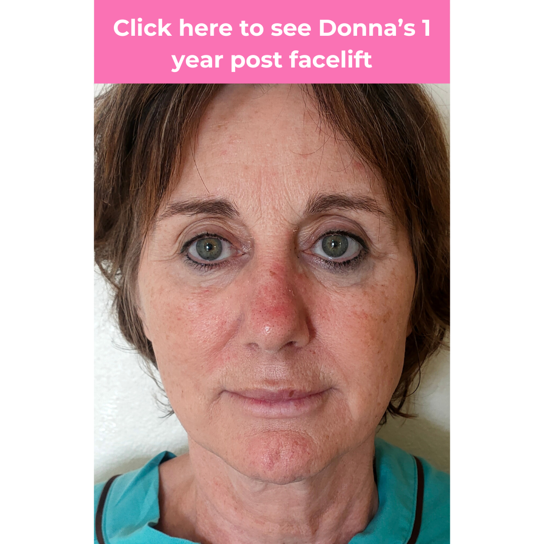 Click to see Donna facelift