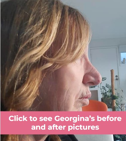 Click to see Georgina facelift