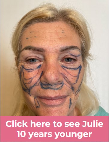 Click to see Julie facelift