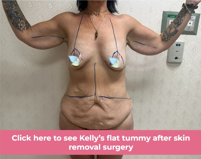 Click to see Kelly St skin removal