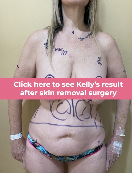 Click to see Kelly skin removal