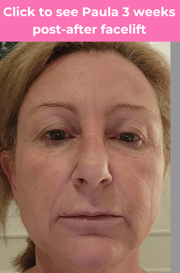 Click to see Paula facelift