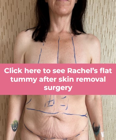 Click to see Rachel skin removal surgery