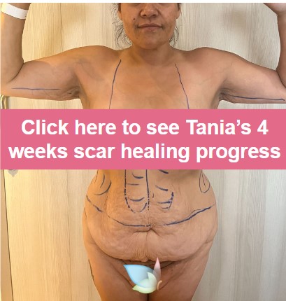 Click to see Tanias 4 weeks po