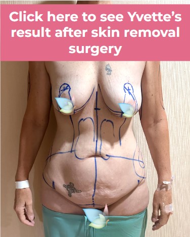 Click to see Yvette skin removal