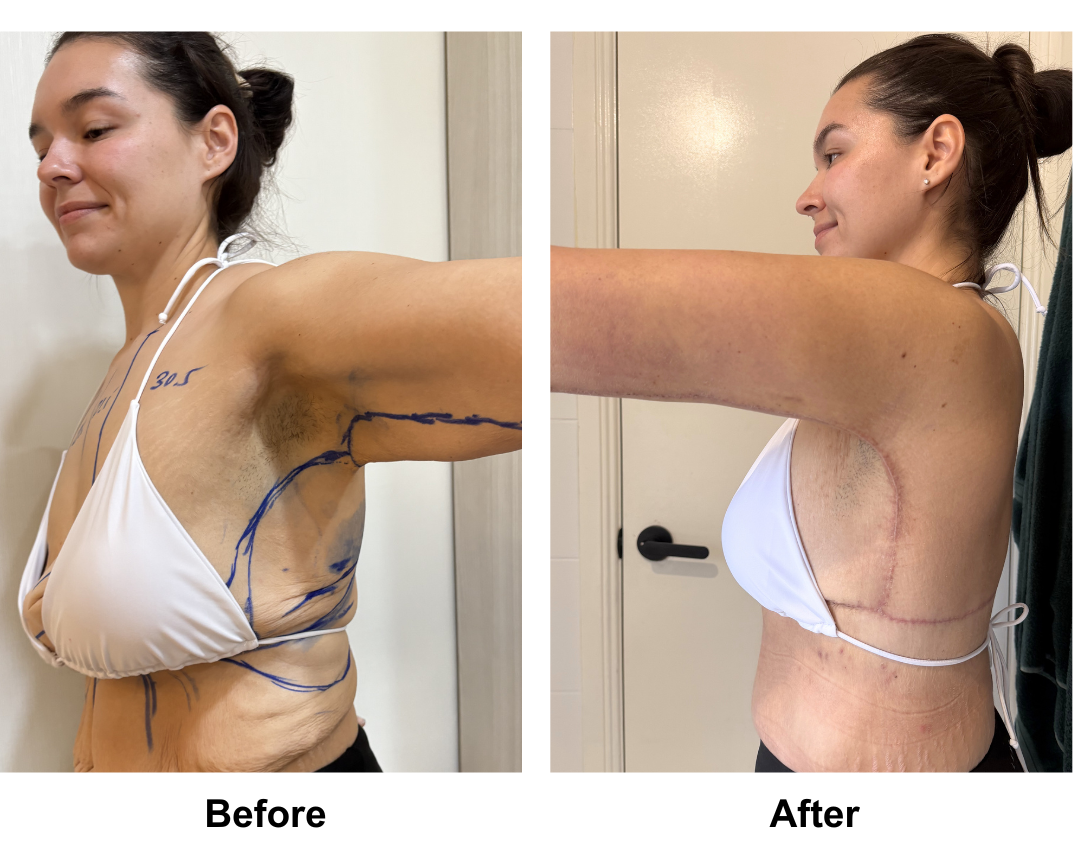 Codie had BL + AL + Side lift + Upper back lift with Dr. Angkana (2)-1