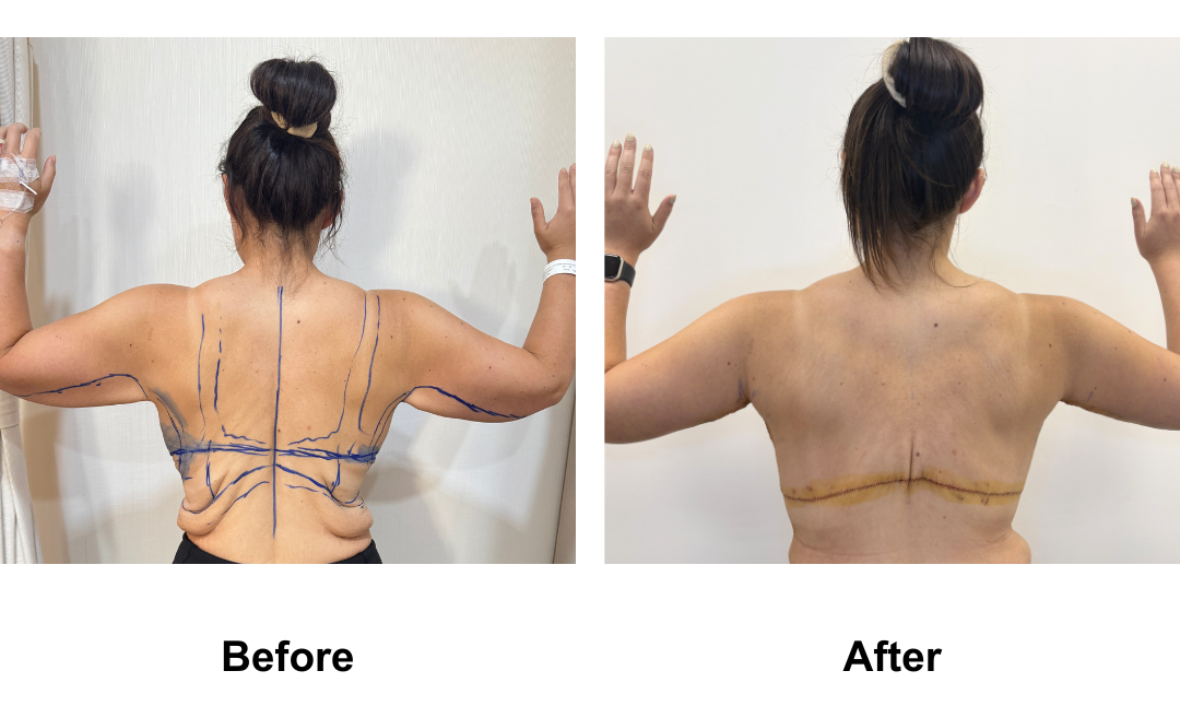 Codie had BL + AL + Side lift + Upper back lift with Dr. Angkana (2)