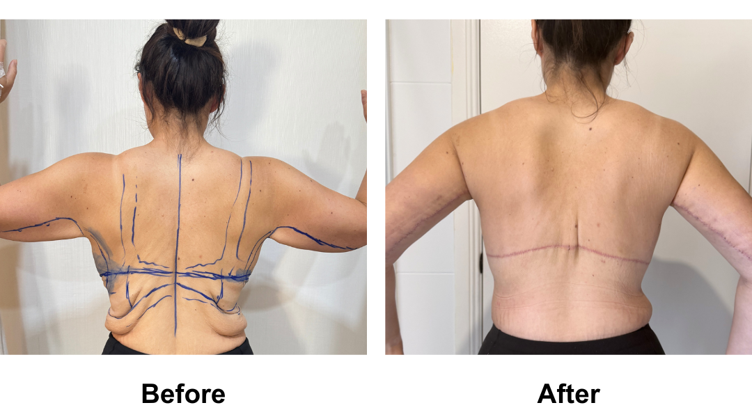 Codie had BL + AL + Side lift + Upper back lift with Dr. Angkana (3)-1