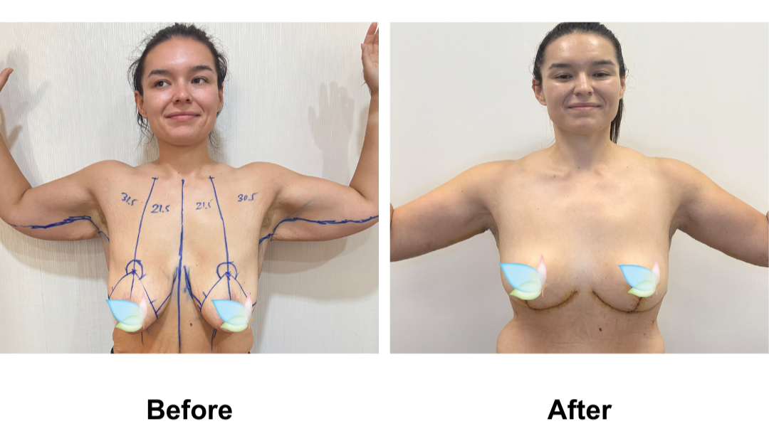 Codie had BL + AL + Side lift + Upper back lift with Dr. Angkana (3)