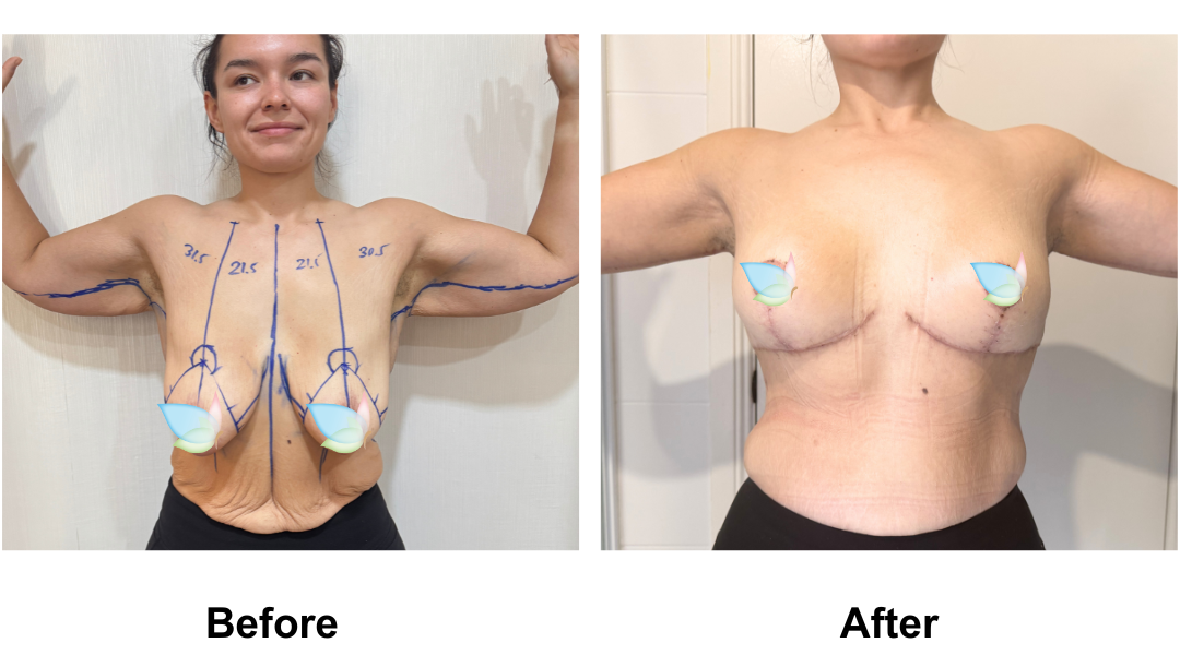 Codie had BL + AL + Side lift + Upper back lift with Dr. Angkana (4)