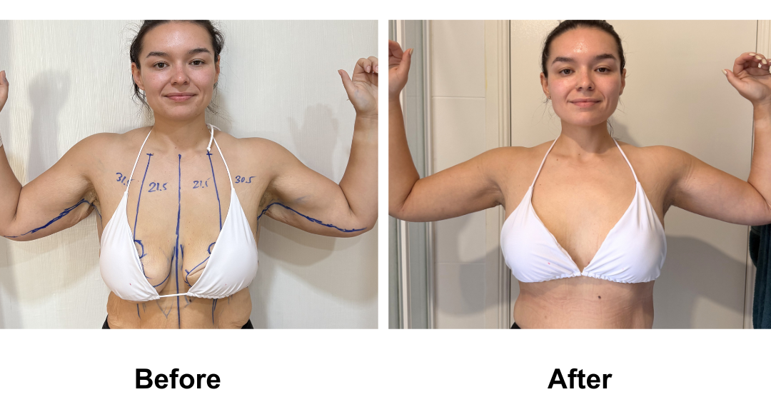 Codie had BL + AL + Side lift + Upper back lift with Dr. Angkana (5)