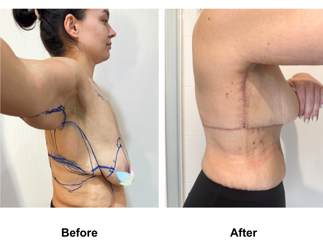 Codie had BL + AL + Side lift + Upper back lift with Dr. Angkana-1