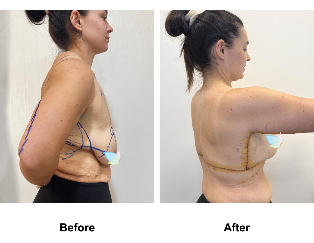 Codie had BL + AL + Side lift + Upper back lift with Dr. Angkana