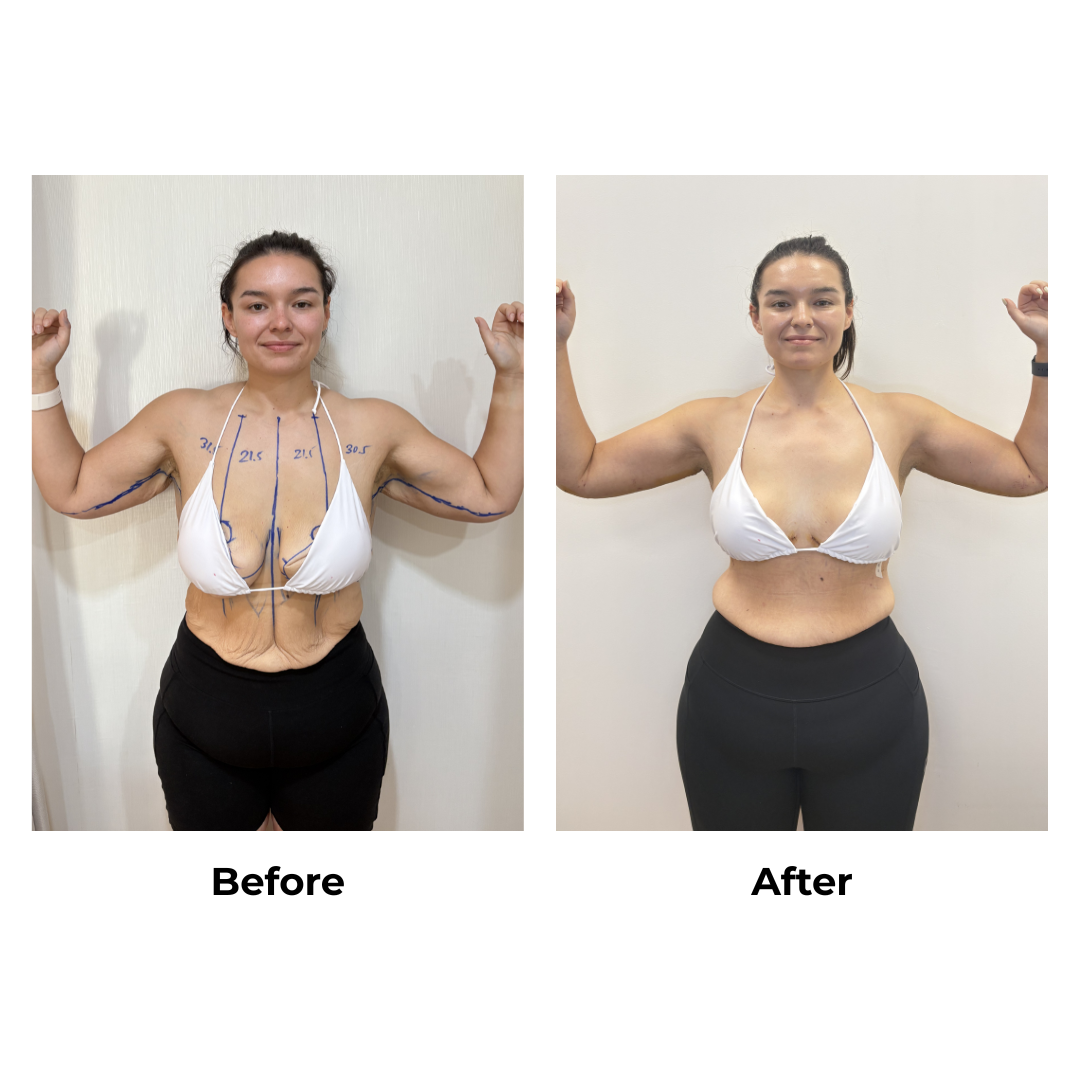 Codie had Upper Back Lift + Arm Lift + Breast Lift + Side Lift with Dr. Angkana