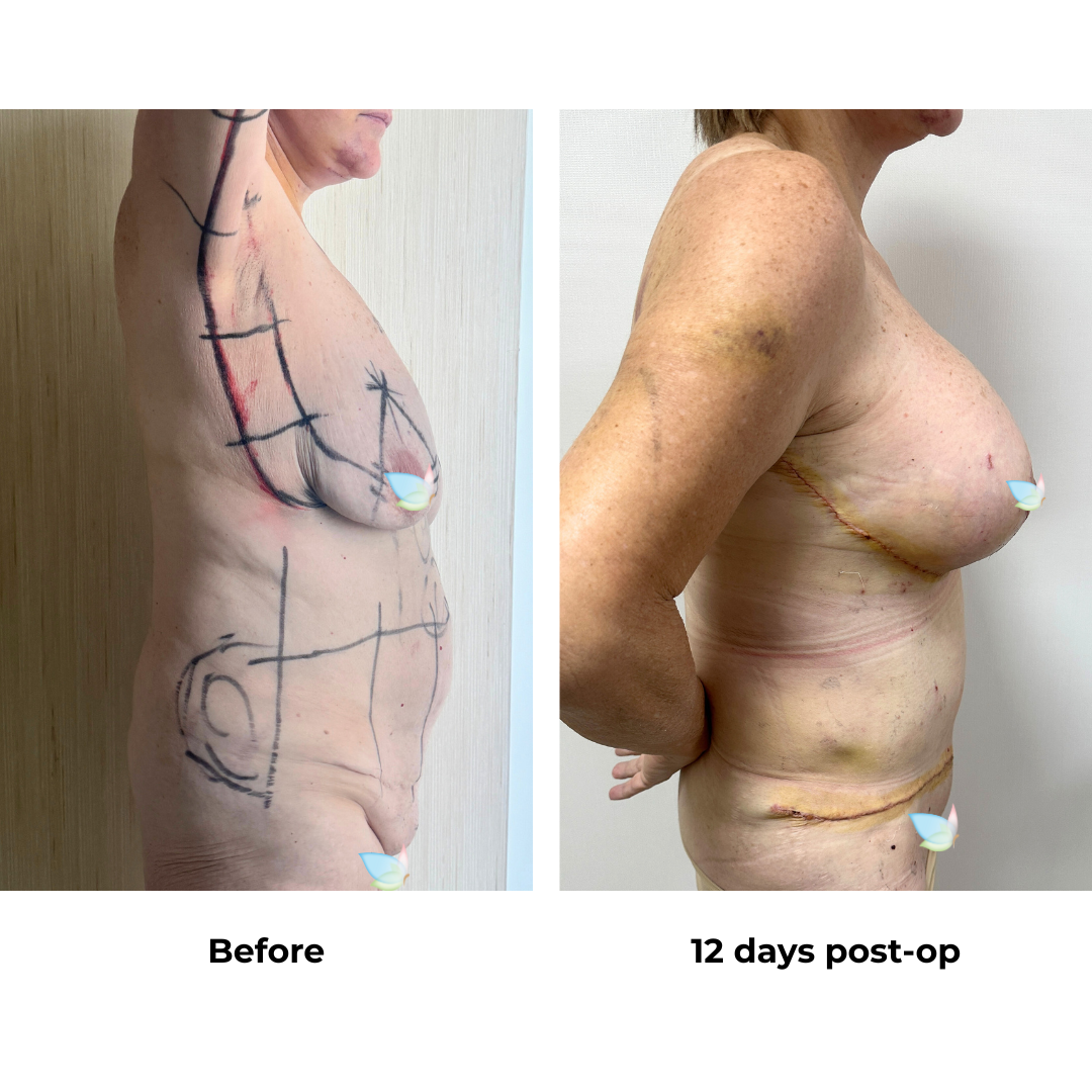 Colleen had BABL(380 cc demi motiva)+AL+Side lift+Lipo x3 (arms, upper abs, love handles) + Rev. ExTT + Mons lift  with Dr. Jatuporn (3)