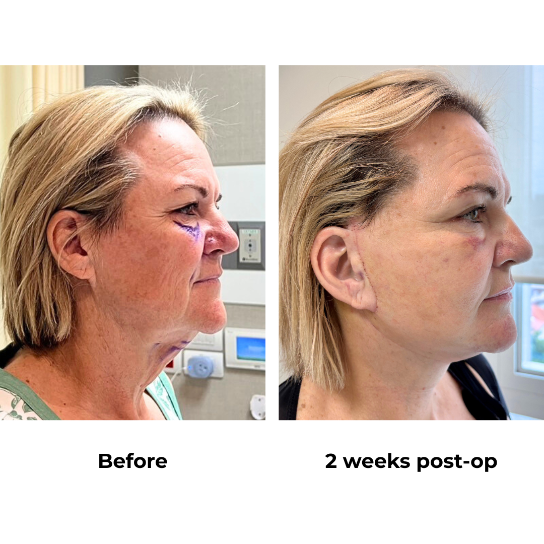 Colleen had MFNL + Chin lift + Fat transfer to under eyes + UB with Dr. NJ (2)