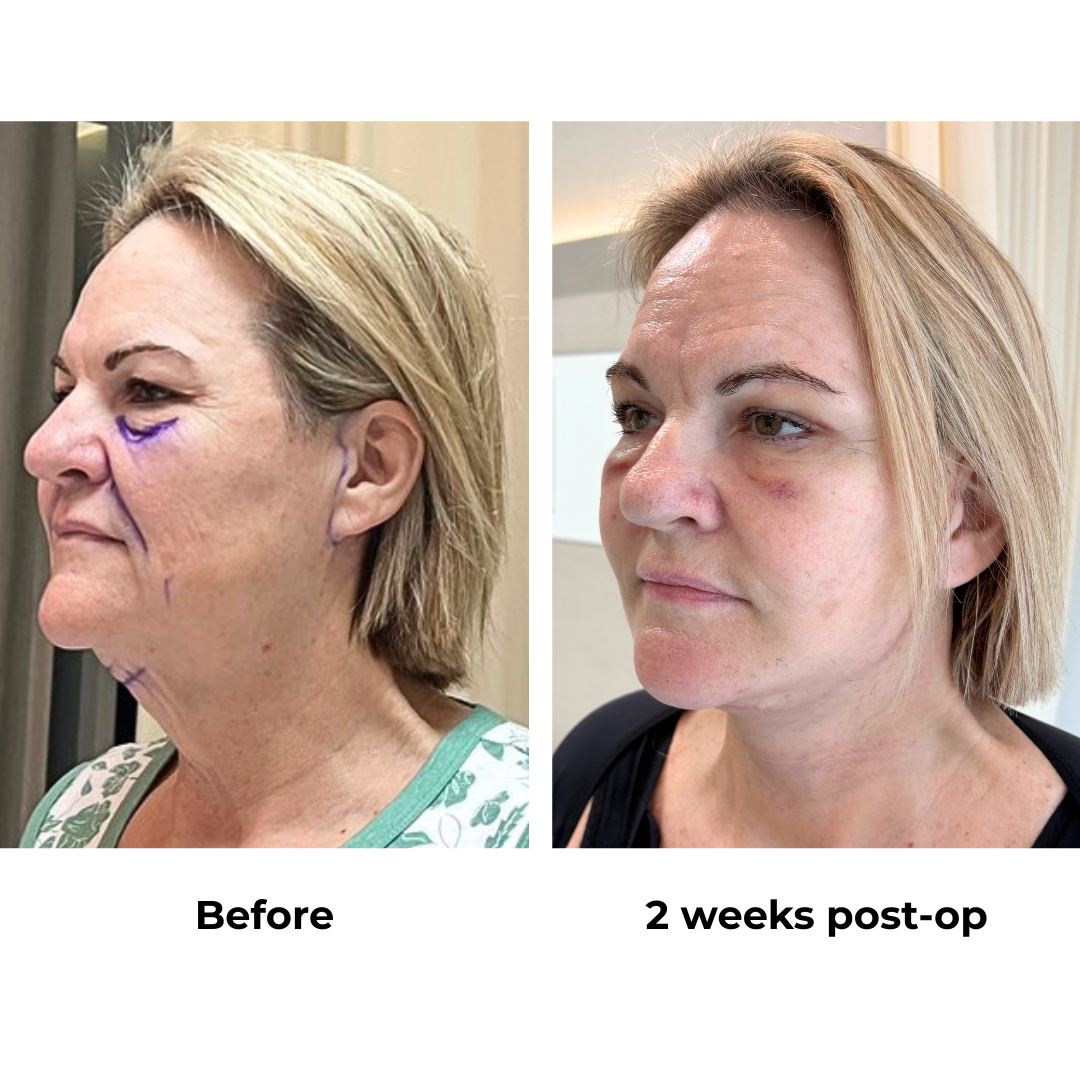 Colleen had MFNL + Chin lift + Fat transfer to under eyes + UB with Dr. NJ (3)