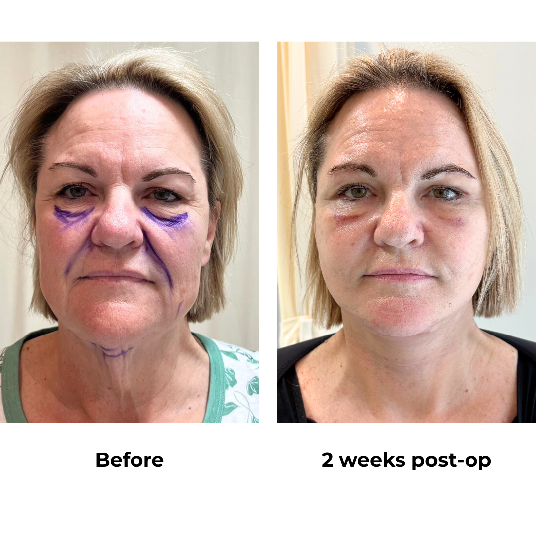 Colleen had MFNL + Chin lift + Fat transfer to under eyes + UB with Dr. NJ