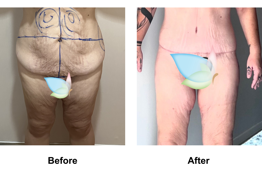 Cora had AL + Ex TT + Lipo_2 + Mons lift with Dr. Angkana 1