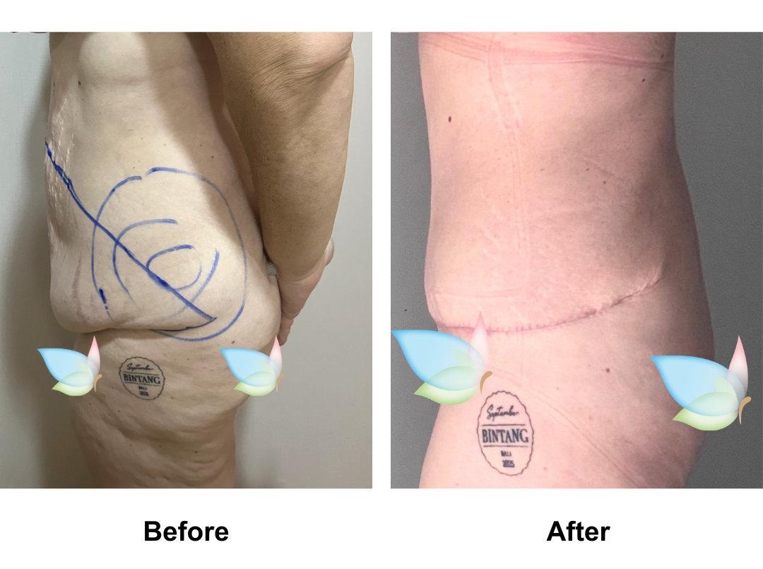 Cora had AL + Ex TT + Lipo_2 + Mons lift with Dr. Angkana 2