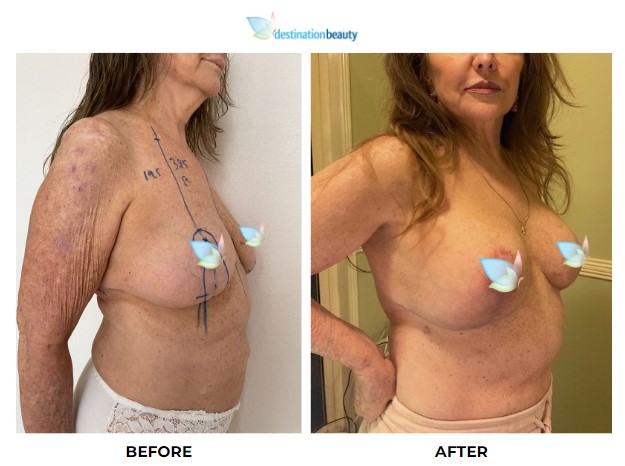 Cynthia breast lift with implants (2)