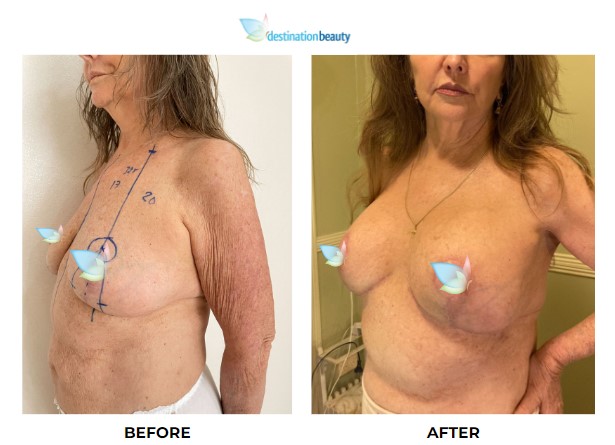 Cynthia breast lift with implants 2