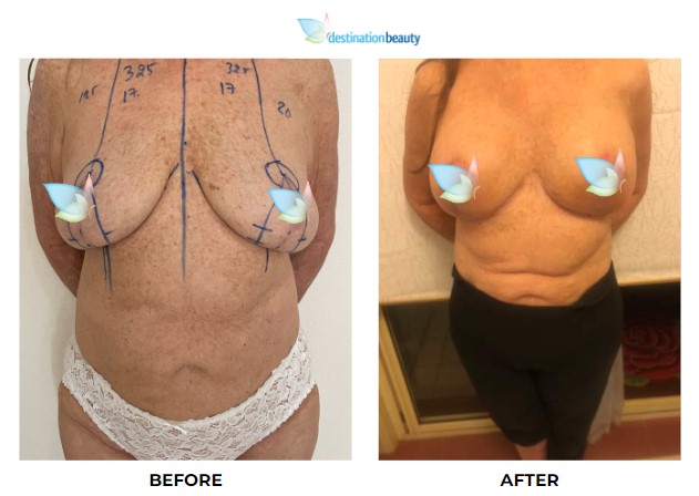 Cynthia breast lift with implants