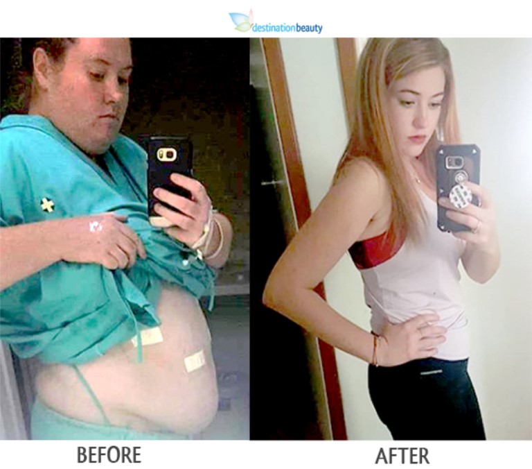 Danica gastric sleeve