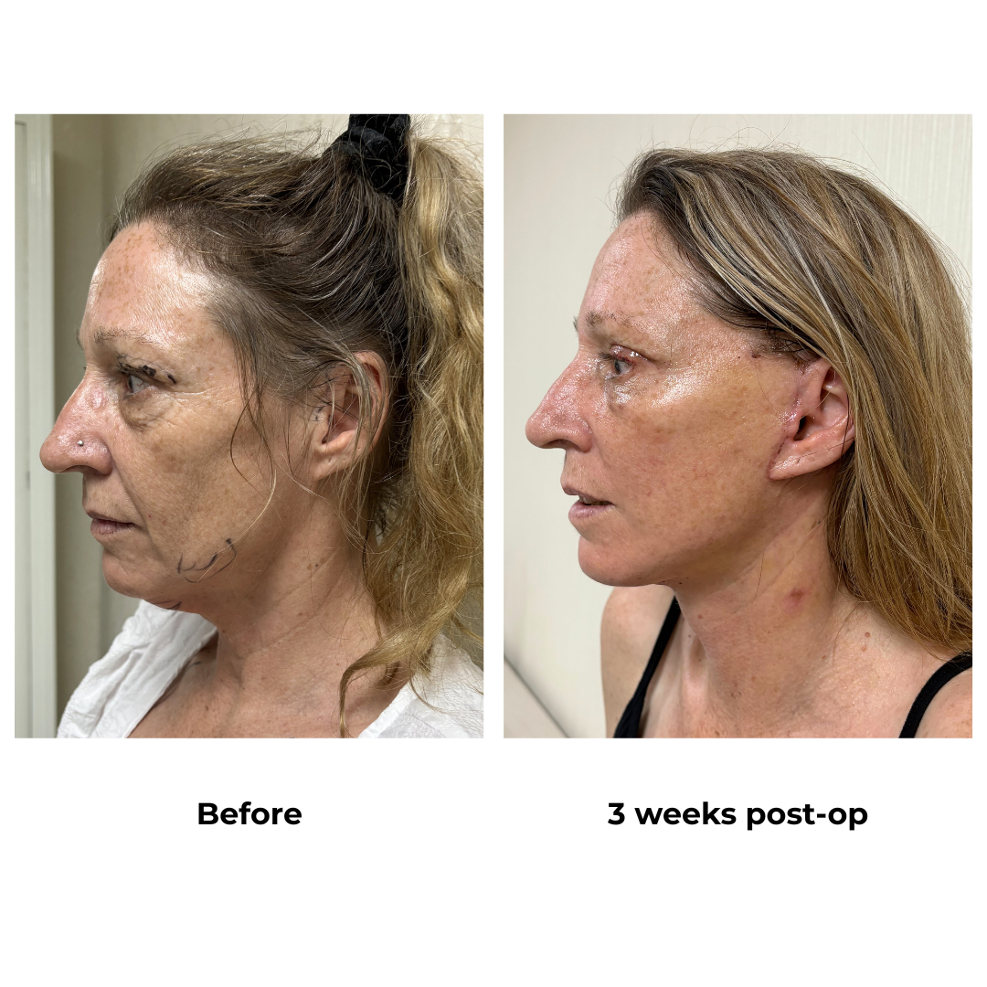 Dannell had MFNL + Chin L + UB with Dr. Ring (2)