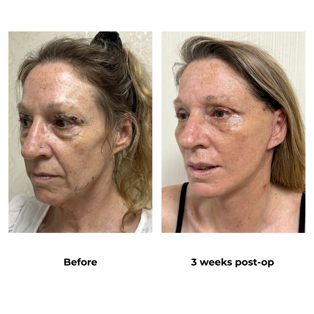 Dannell had MFNL + Chin L + UB with Dr. Ring (3)